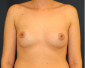 Feel Beautiful - Breast Revision 406 - Before Photo
